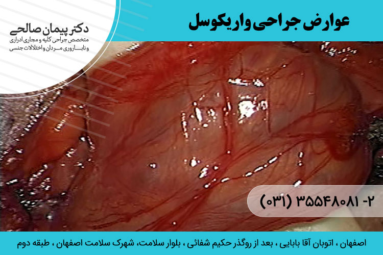 جراحی واریکوسل در اصفهان